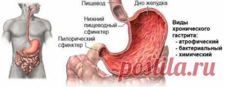 Народные методы лечения хронического гастрита