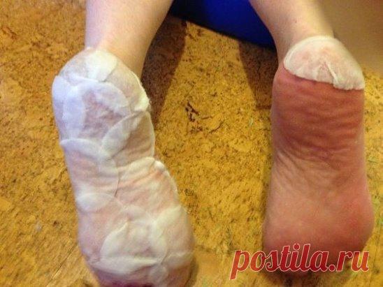 Ороговевшая кожа ног?
 Это средство лучше пемзы и даже электрической пилки!