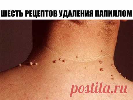 ШЕСТЬ РЕЦЕПТОВ УДАЛЕНИЯ ПАПИЛЛОМ

Первый рецепт.

Для избавления от папиллом в домашних условиях рекомендуется использовать порошок, приготовленный из хорошо просушенных семян расторопши, благотворно действующего на организм в целом. Данный порошок следует принимать по одной чайной ложечке трижды – четырежды в день, запивая его водой. При этом до приёма пищи с момента приёма должно пройти не менее двух часов.

Второй рецепт.

Одним из самых эффективных популярных наружных ...