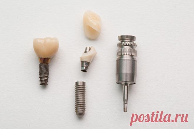 Имплантация зубов в Омске. Цены на имплантацию в 2022 году | Стоматология АлексДент