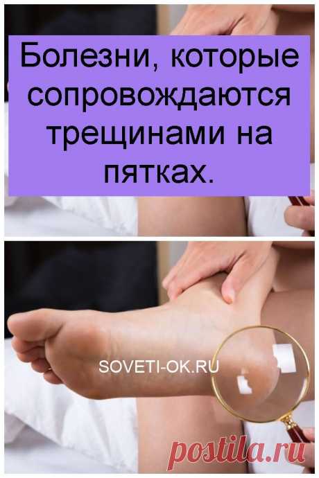 Болезни, которые сопровождаются трещинами на пятках.