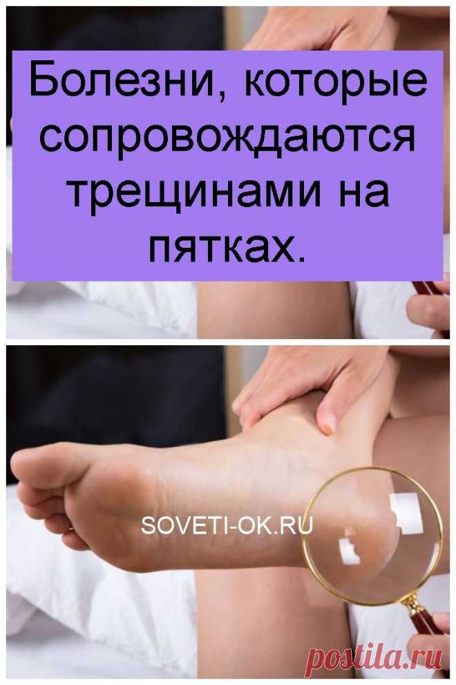 Болезни, которые сопровождаются трещинами на пятках.