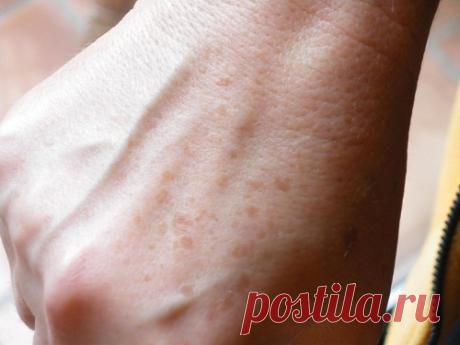 Как избавиться от пигментных пятен и веснушек на руках — В РИТМІ ЖИТТЯ