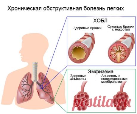 ХОБЛ (Хроническая обструктивная болезнь легких)