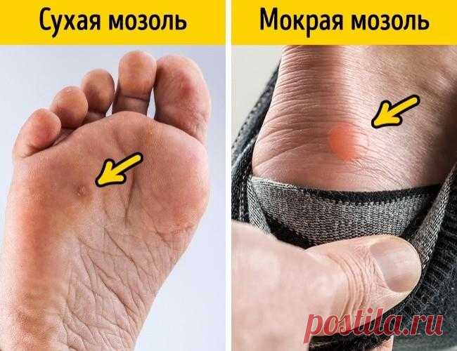 11 легких способов вылечить мозоль от неудобной обуви Напасть всех любителей красивой обуви существует в двух состояниях. Сухом — твердые, плотные мозоли, похожи на натоптыши. Мокром — волдыри, которые рискуют лопнуть в любой момент. Хорошая новость: и т...