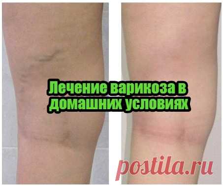 Лечение варикоза в домашних условиях