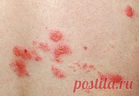 О чем свидетельствует сыпь на теле у взрослого человека