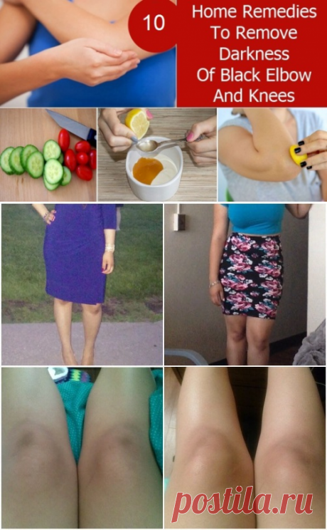 How to Get Rid of  Dark Knees and Elbows | Virtual Clinic