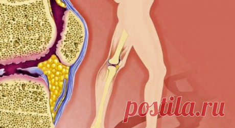 Продукты, которые нужно срочно исключить при артрите