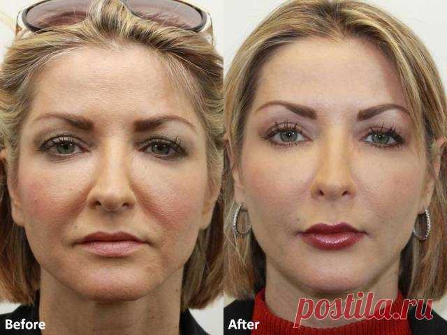 Даже самая дряблая кожа лица подтянется после этой процедуры! Делай это раз в неделю