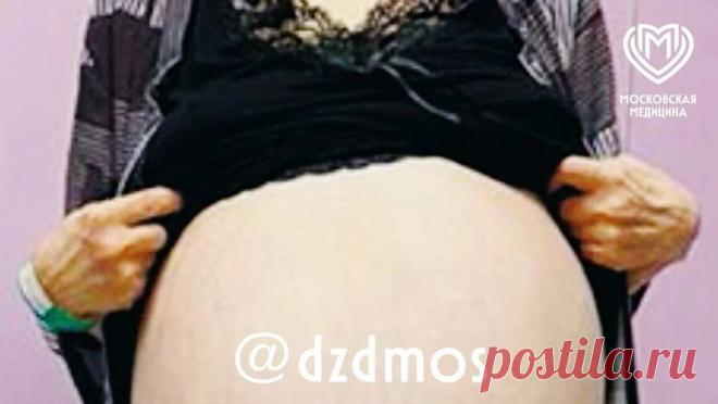 Московские врачи удалили женщине опухоль яичника весом более 30 кг. В Москве женщине, которая 15 лет не ходила к гинекологу, удалили гигантскую опухоль яичника. Об этом сообщает Telegram-канал "Московская медицина". Пациентка поступила в больницу с жалобами на боли и увеличение живота, которое ...