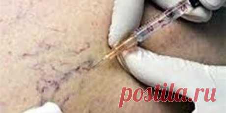 Причины варикозного расширения вен (digest.health) : Рассылка : Subscribe.Ru
