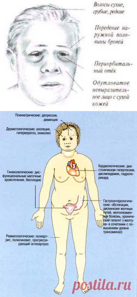 Недостаточность щитовидной железы, симптомы , лечение | Правила здоровья и долголетия