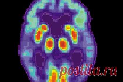 Подтверждена альтернативная гипотеза о болезни Альцгеймера. Ученые Университета Цинциннати подтверждают гипотезу о том, что болезнь Альцгеймера вызвана снижением уровня определенного белка, что противоречит преобладающей теории о накоплении бляшек. Согласно результатам нового исследования, ключевую роль играет снижение растворимого бета-амилоида.