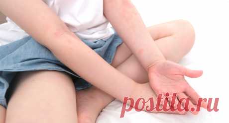 Атопический дерматит | причины, симптомы, лечение, общие рекомендации