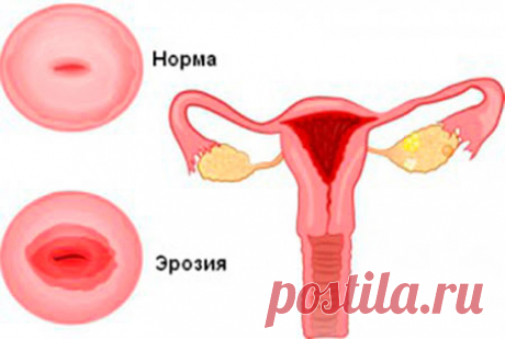 Эрозия шейки матки после родов: причины, признаки, лечение