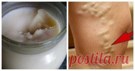 Рецепт наших предков: Забытая волшебная мазь от варикозного расширения вен