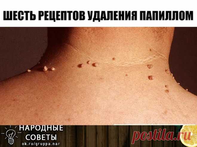 ШЕСТЬ РЕЦЕПТОВ УДАЛЕНИЯ ПАПИЛЛОМ ШЕСТЬ РЕЦЕПТОВ УДАЛЕНИЯ ПАПИЛЛОМ

Первый рецепт.

Для избавления от папиллом в домашних условиях рекомендуется использовать порошок, приготовленный из хорошо просушенных семян расторопши, благотворно действующего на организм в целом. Данный порошок следует принимать по одной чайной ложечке трижды – четырежды в день, запивая его водой. При этом до приёма пищи с момента приёма должно пройти не менее двух часов.

Второй рецепт.

Одним из самых...