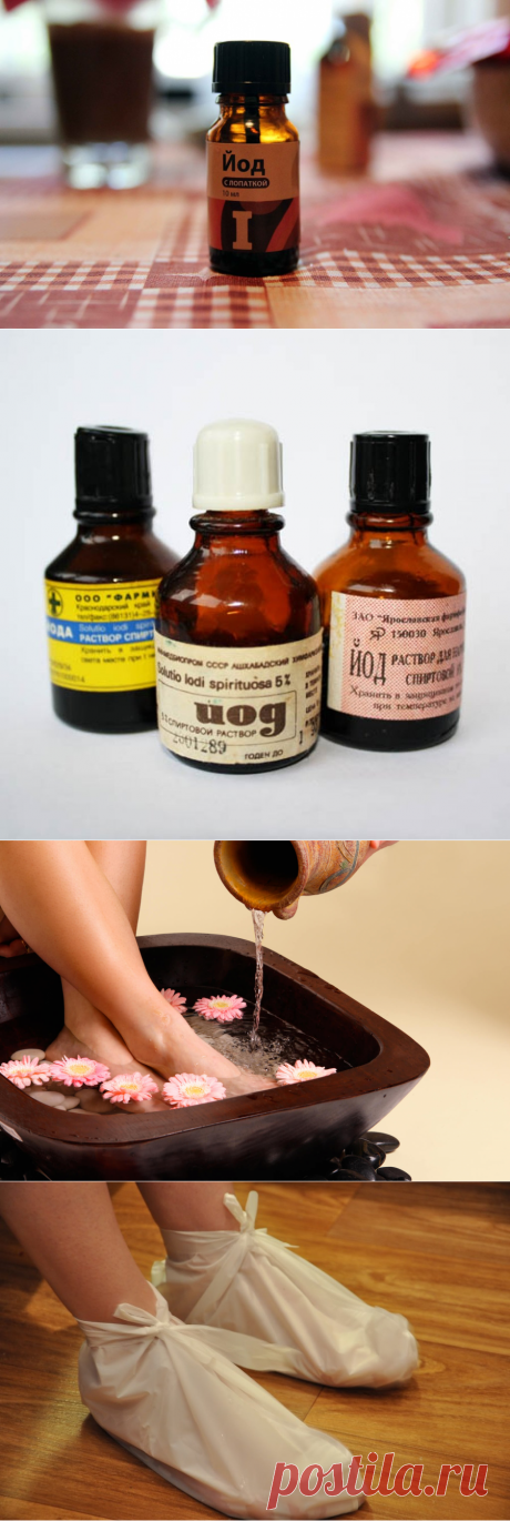 Лечение пяточной шпоры йодом
