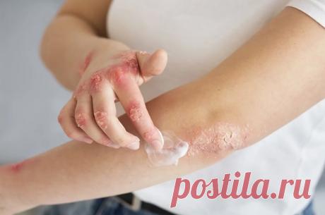 6 заразных кожных инфекций. Пятна и зуд Кожные инфекции — одна из самых распространённых и в то же время коварных групп заболеваний. Их опасность заключается в лёгкости передачи: достаточно мимолётного контакта с заражённым человеком, его личными вещами или даже поверхностями в общественных местах.