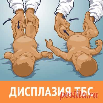 Симптомы и признаки развития врожденного вывиха бедра у детей. Статья от магазина одежды при дисплазии под стремена, гипс, распорки