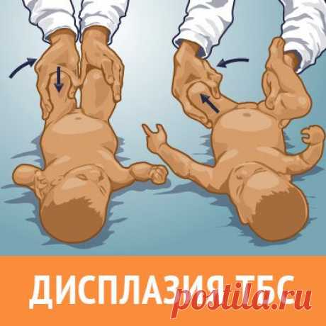Симптомы и признаки развития врожденного вывиха бедра у детей. Статья от магазина одежды при дисплазии под стремена, гипс, распорки