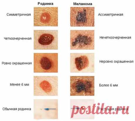 Проверьте родинку! В каких случаях нужно срочно к врачу