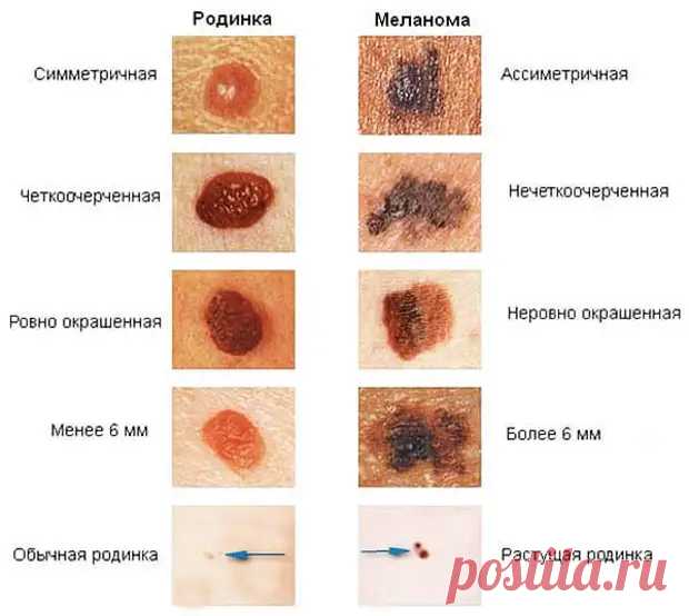 Проверьте родинку! В каких случаях нужно срочно к врачу