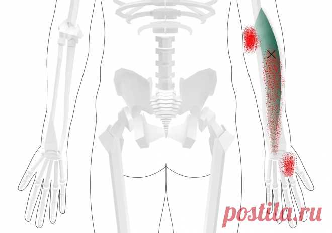 Плечелучевая мышца. Самомассаж