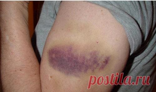 Почему на теле появляются синяки без причины