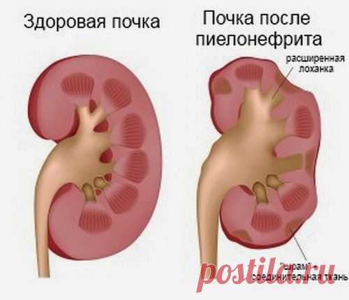 Хронический пиелонефрит - симптомы, диагностика и лечение