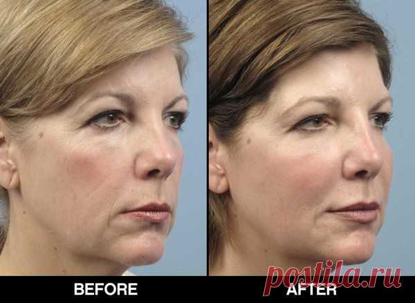 Термаж подтяжка лица без скальпеля хирурга
