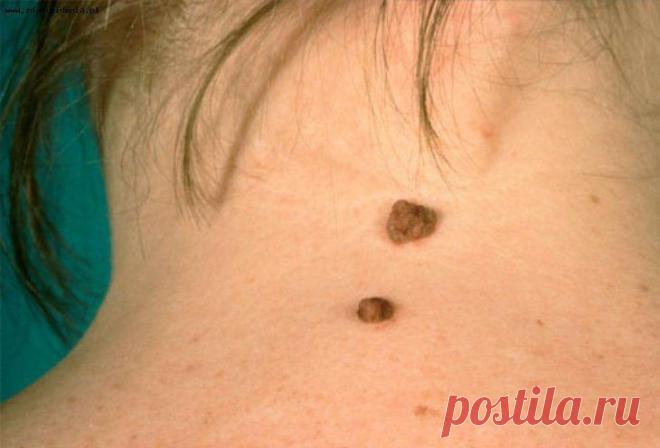 Родинка — пигментный невус.
