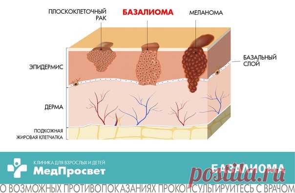 Базалиома или базальный рак кожи: симптомы, диагностика, лечение

Базалиома - рак кожи, развивающийся из атипичных базальных клеток эпидермиса и фолликулярного эпителия. В отличии от меланомы медленно прогрессирует и не дает метастазов. Первоначально опухоль развивается в дерме, но при отсутствии лечения может переходить в сухожилия, мышцы, хрящи и даже кости.
Показать полностью...
