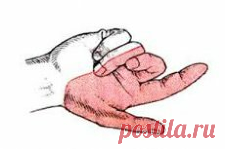 Нейропатия срединного нерва руки