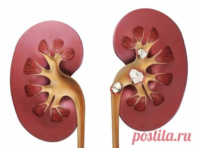 Камни в почках. Рецепты народной медицины