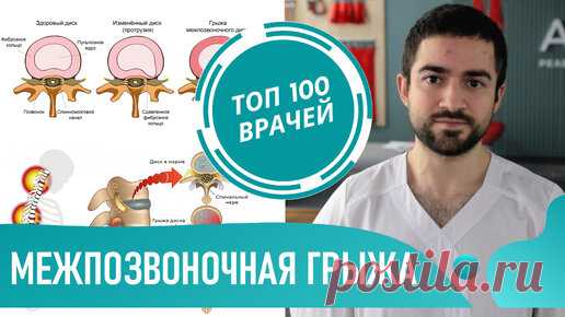 Грыжа пройдет сама? Межпозвоночная грыжа - симптомы и лечение. Резорбция грыжи | ТОП 100 ВРАЧЕЙ | Дзен