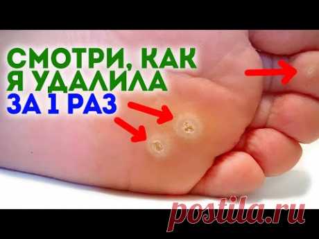 Как быстро избавиться от мозолей? Смотрите, дёшево, и на собственной кухне беру обычную