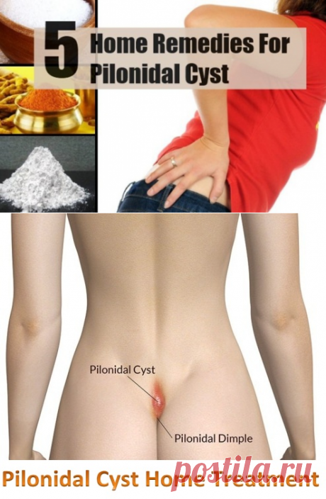 Home Remedies for Pilonidal Cyst | Virtual Clinic
