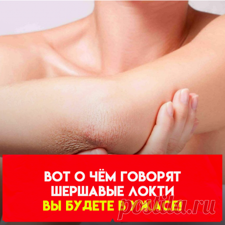 чаще всего чрезмерная сухость и шелушение кожи на локтях являются признаками того или иного дерматологического заболевания. В частности, речь может идти о псориазе. Если сухость очень сильная, появилось покраснение, а к ним добавился зуд, то эти симптомы могут быть признаками ихтиоза.Еще одной причиной сухости локтей и даже изменения цвета кожи может быть кратковременное или продолжительное снижение чувствительности клеток к инсулину