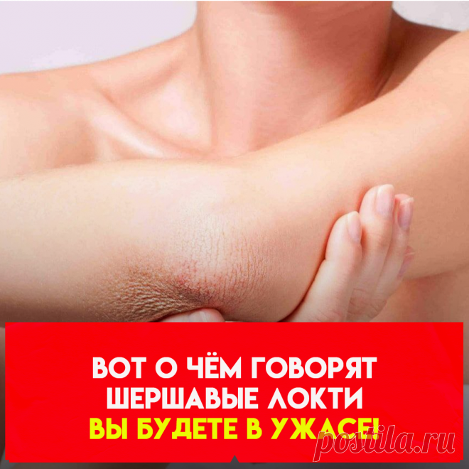 чаще всего чрезмерная сухость и шелушение кожи на локтях являются признаками того или иного дерматологического заболевания. В частности, речь может идти о псориазе. Если сухость очень сильная, появилось покраснение, а к ним добавился зуд, то эти симптомы могут быть признаками ихтиоза.Еще одной причиной сухости локтей и даже изменения цвета кожи может быть кратковременное или продолжительное снижение чувствительности клеток к инсулину