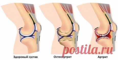 Хруст в суставах и его основной источник!