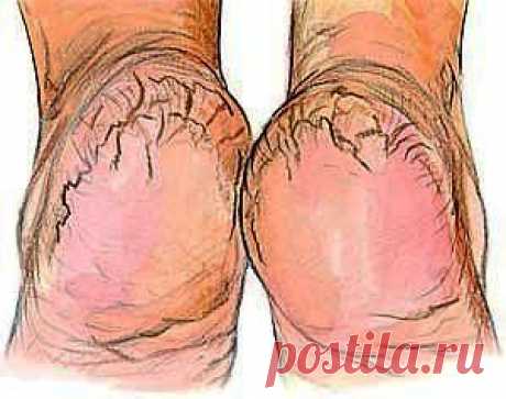 Чудодейственный крем, своими руками, для спасения Ваших пяток..