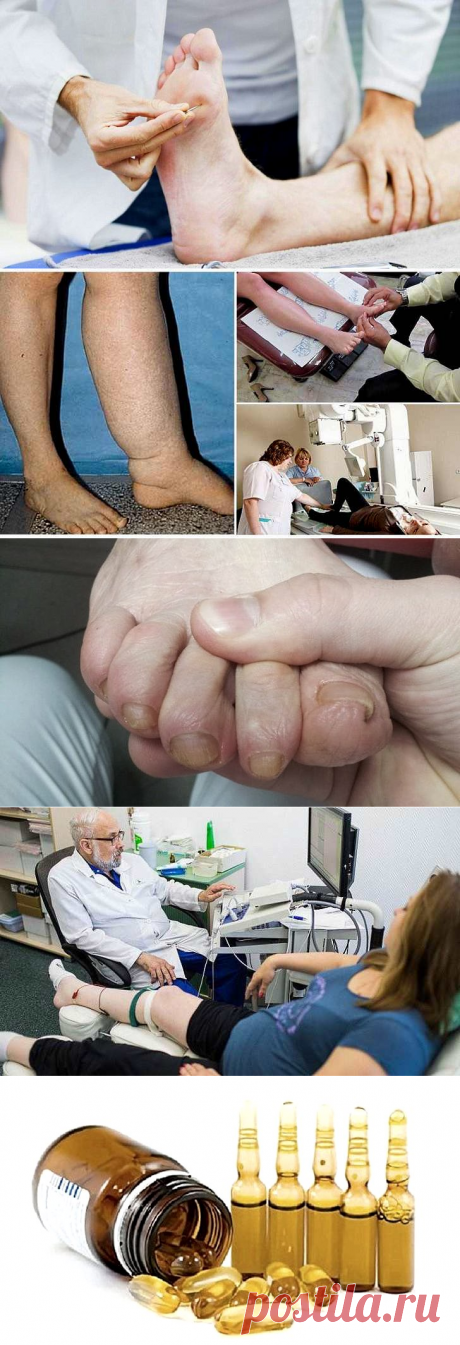 Диабетическая полинейропатия - это осложнение сахарного диабета