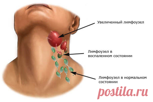 ОЧИЩЕНИЕ ЛИМФАТИЧЕСКИХ УЗЛОВ И ПРОТОКОВ

#ВЪДИ #Исторiя #Человъкъ #Образованiе #Питаніе #Народъ #Книгi

Очистка лимфатической системы - обязательный шаг на пути к здоровью. Это возможность избежать многих болезней и очистить организм.

Очищение лимфатической системы 
Очищать лимфатическую систему так же важно, как и другие органы и системы нашего организма.

Лимфатическая система включает в себя:

- лимфатические узлы,
- сосуды,
- капилляры,
- межклеточную жидкость.

Лимфа...