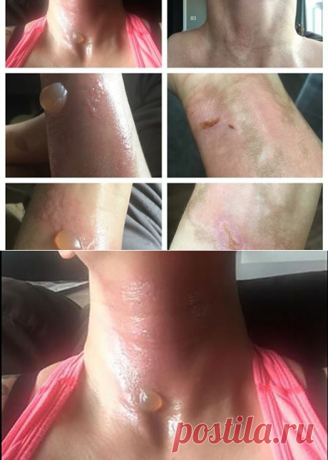 Ее кожа была покрыта отвратительными волдырями, и боль была невыносимой. Когда она вспомнила, что она сделала накануне, то ужаснулась! - Советы для женщин