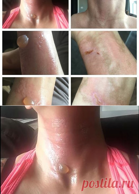 Ее кожа была покрыта отвратительными волдырями, и боль была невыносимой. Когда она вспомнила, что она сделала накануне, то ужаснулась! - Советы для женщин