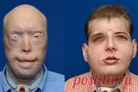 Команда хирургов из Медицинского центра Лангон при Университете Нью-Йорка провела самую сложную и самую обширную в мире хирургическую операцию по пересадке лица.