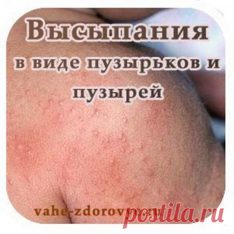 Высыпания в виде пузырьков и пузырей | Быть здоровым легко!