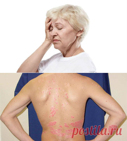 Псориаз, причины возникновение у мужчин и женщин